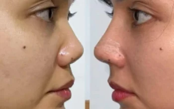 Rina Nose Buka Suara: Post‑Op Blues Mengguncang Setelah Operasi Hidung, Kini Pilih Hidup Childfree