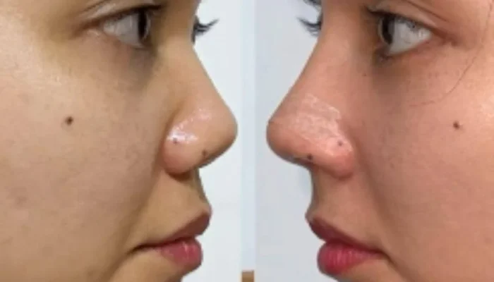 Rina Nose Buka Suara: Post‑Op Blues Mengguncang Setelah Operasi Hidung, Kini Pilih Hidup Childfree