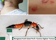 Mengatasi Gatal dan Menangani Gigitan Serangga dengan Tepat, serta Berita Terkini Lainnya