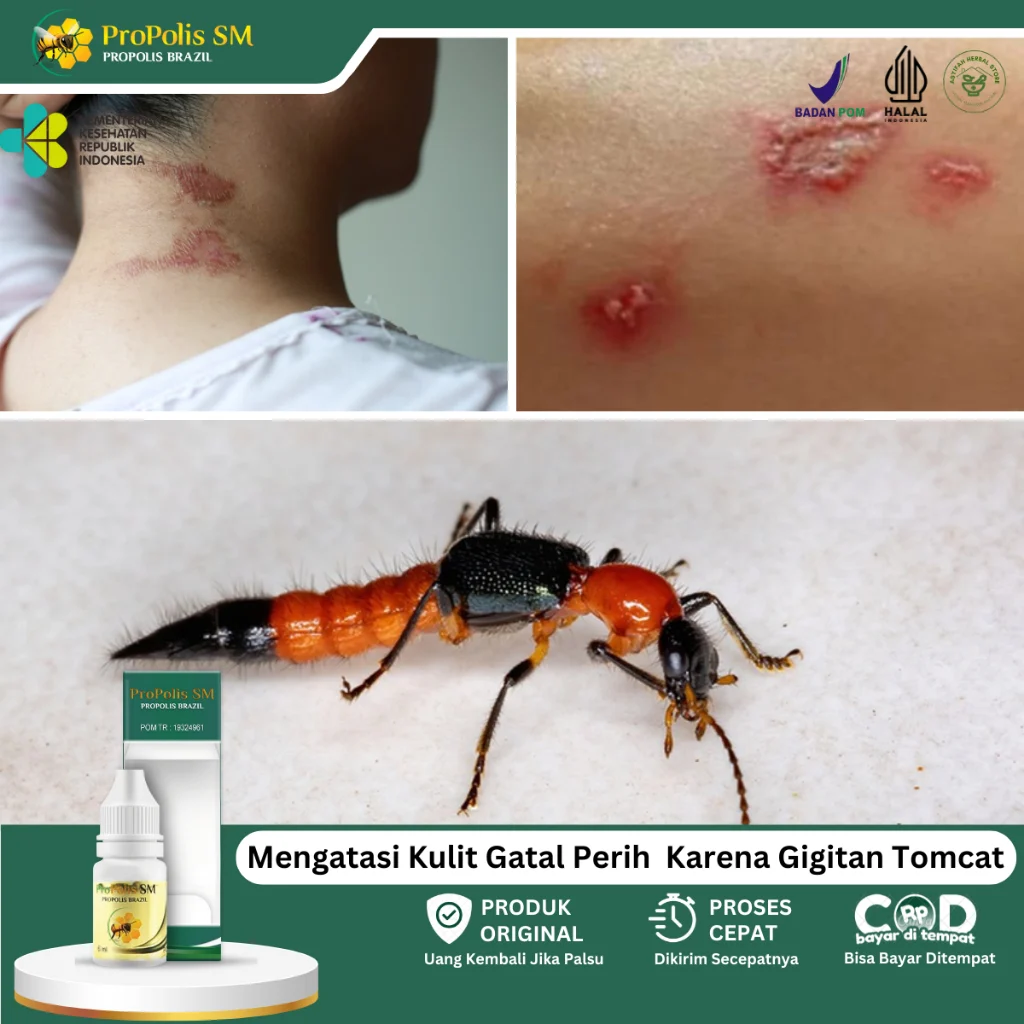 Mengatasi Gatal dan Menangani Gigitan Serangga dengan Tepat, serta Berita Terkini Lainnya